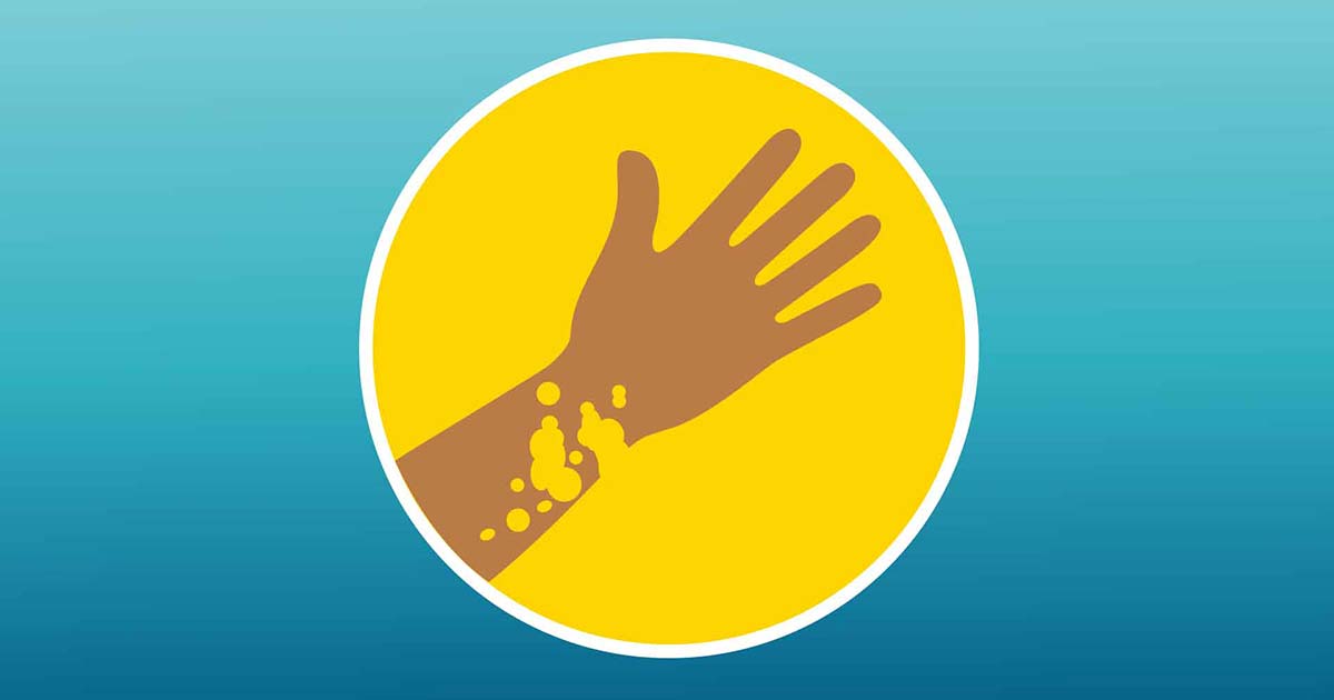 Chronic Urticaria In the Hispanic/Latino Community