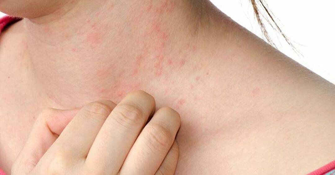 close up of a woman itching the bumbs on her neck