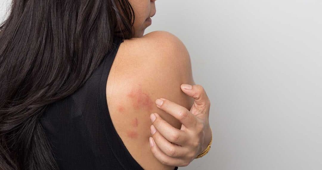 A person with long dark hair is shown from the side, wearing a black sleeveless top. They are scratching a patch of red, irritated skin on their upper arm.