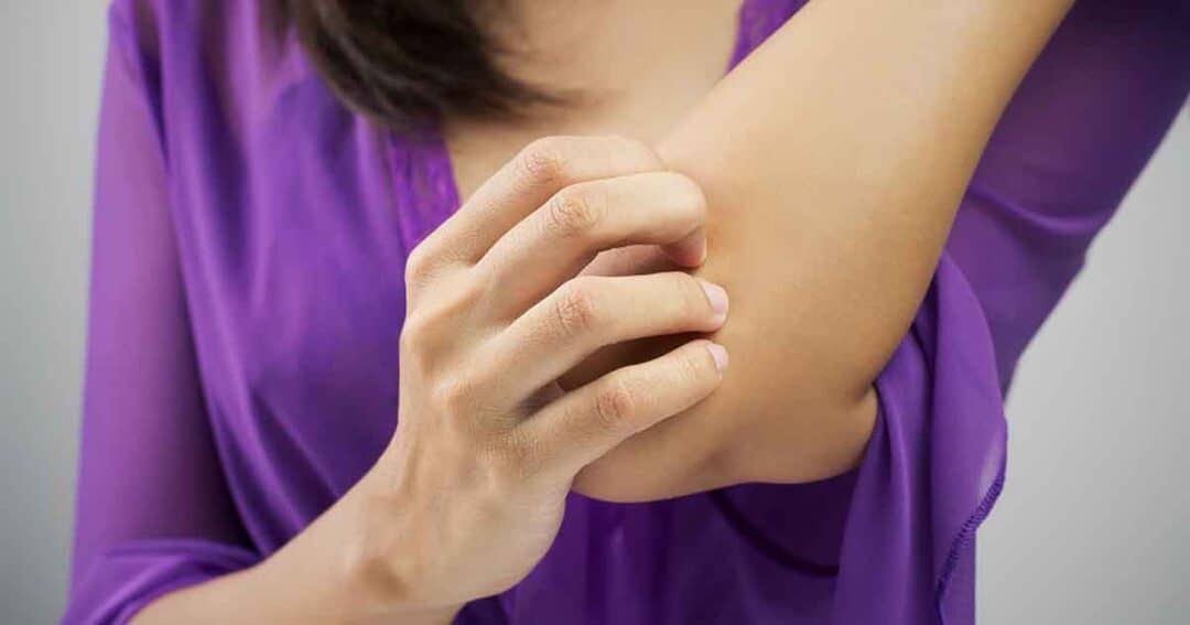 A person wearing a purple shirt scratches their elbow with their right hand. The focus is on the arm and hand, suggesting discomfort or itchiness.